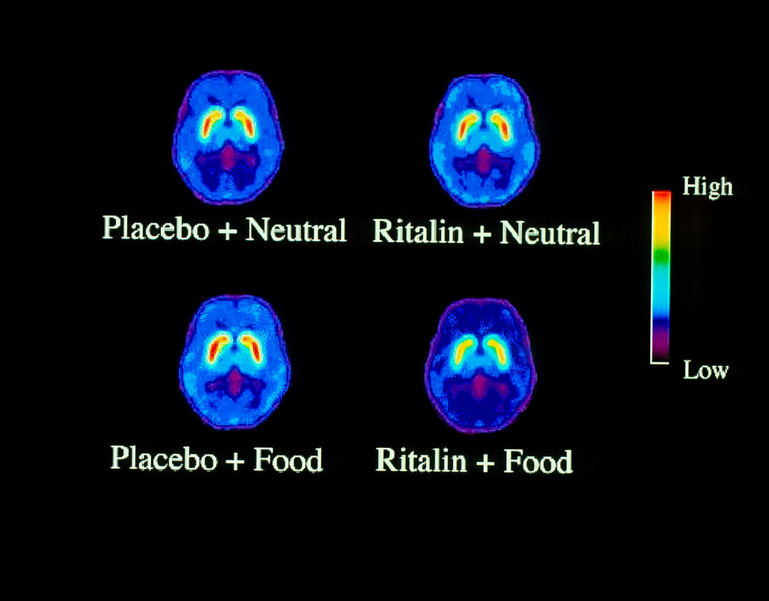 Food addiction brain research,PET scans