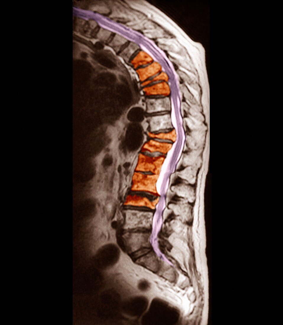 Spinal osteoporosis,MRI scan