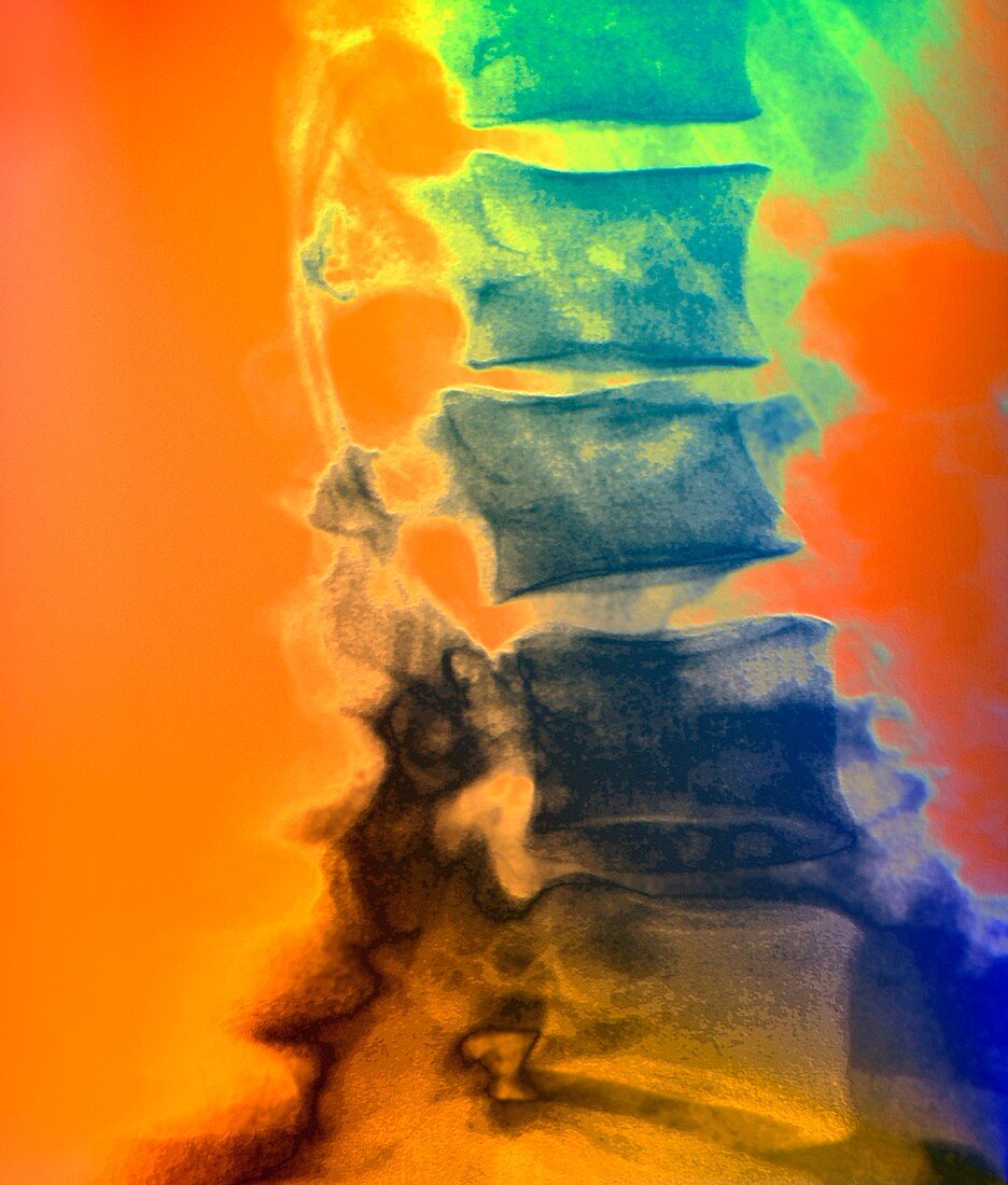 Osteoporotic spine,X-ray