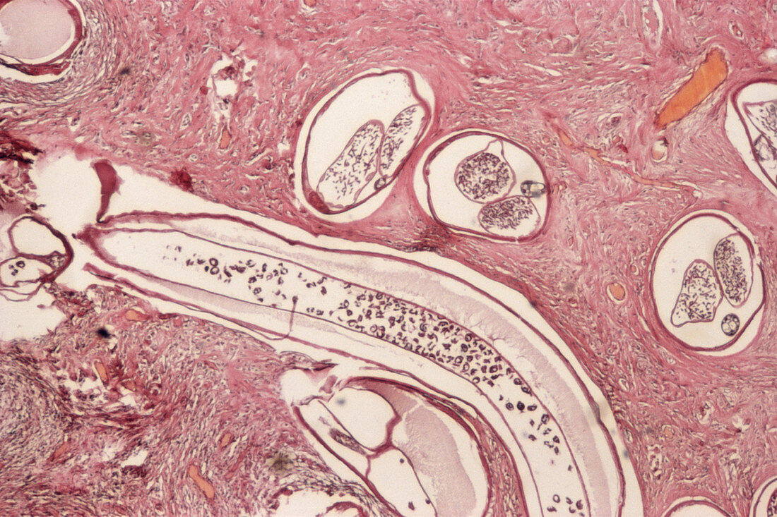 Onchocerca volvulus parasites