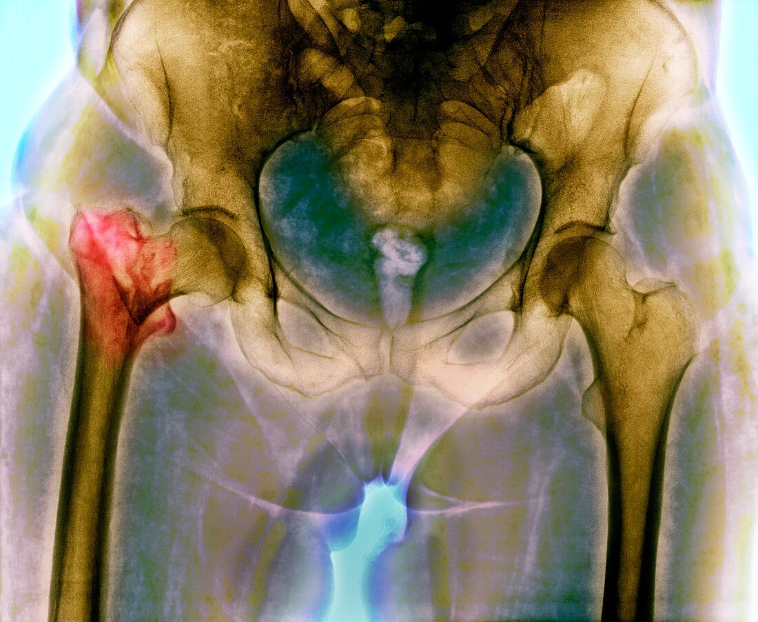 Fractured osteoporotic hip,X-ray