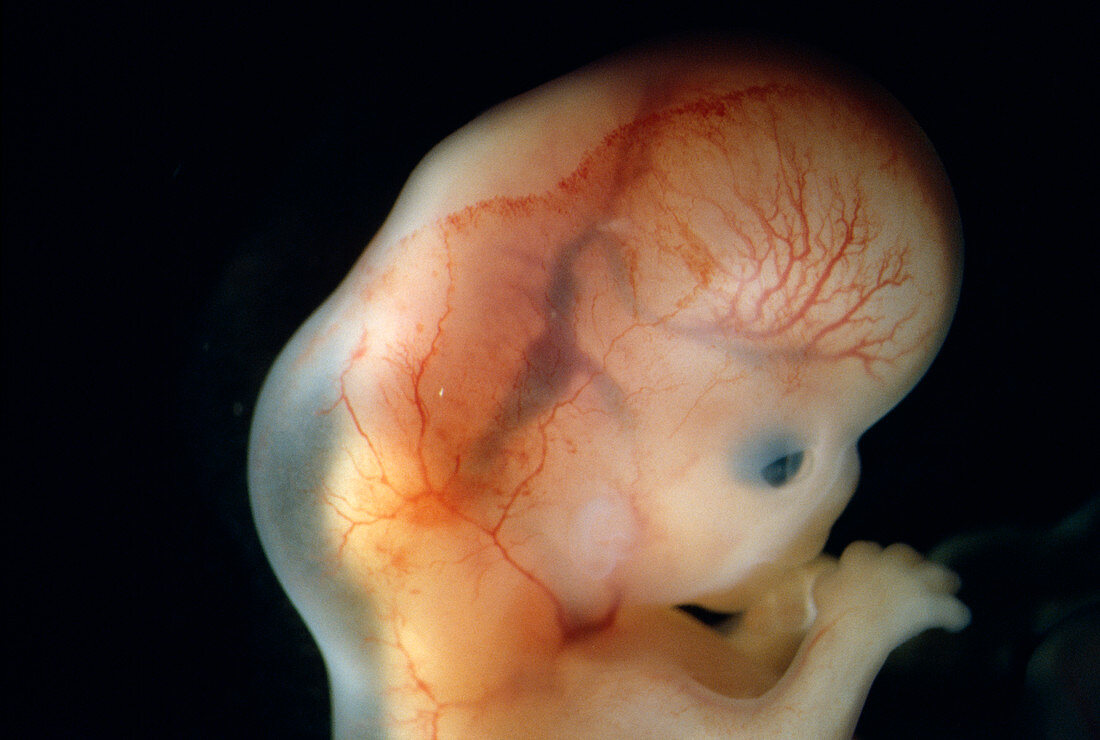 Foetal neck oedema
