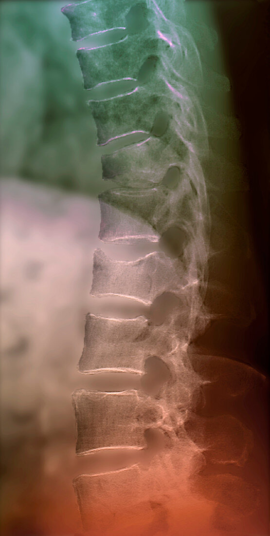Spinal osteoporosis,X-ray