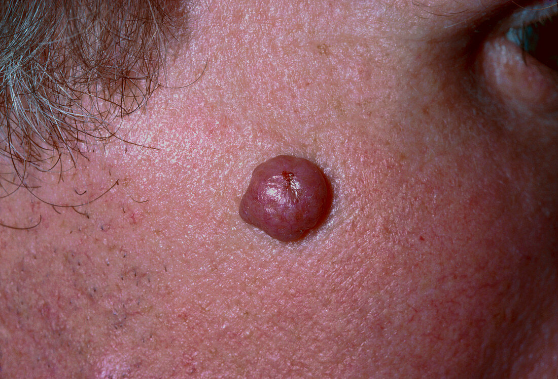 Close-up of intradermal naevus on man's face
