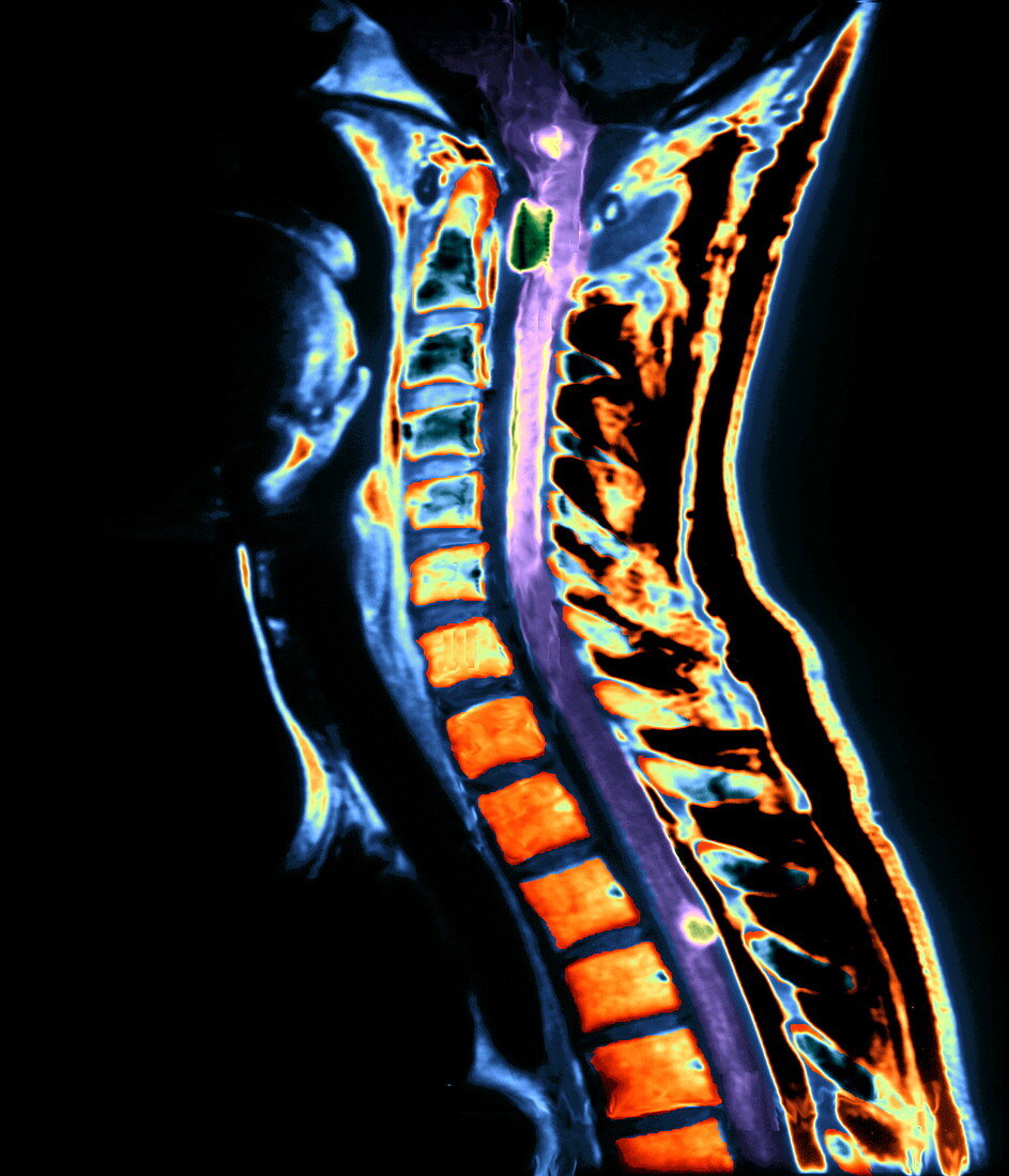 Spinal neurofibromas,MRI scan