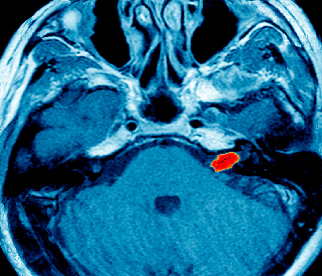 Acoustic nerve tumour,head MRI scan
