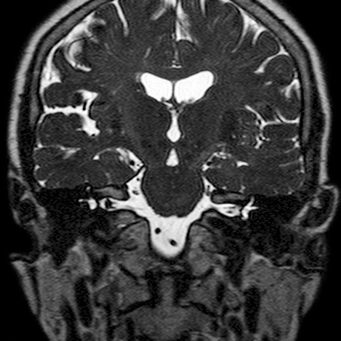 Acoustic neuroma,MRI scan