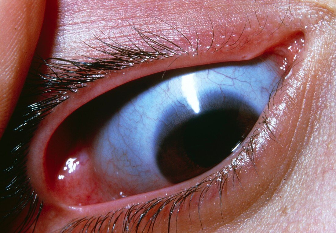 Blue sclera of eye in osteogenesis imperfecta