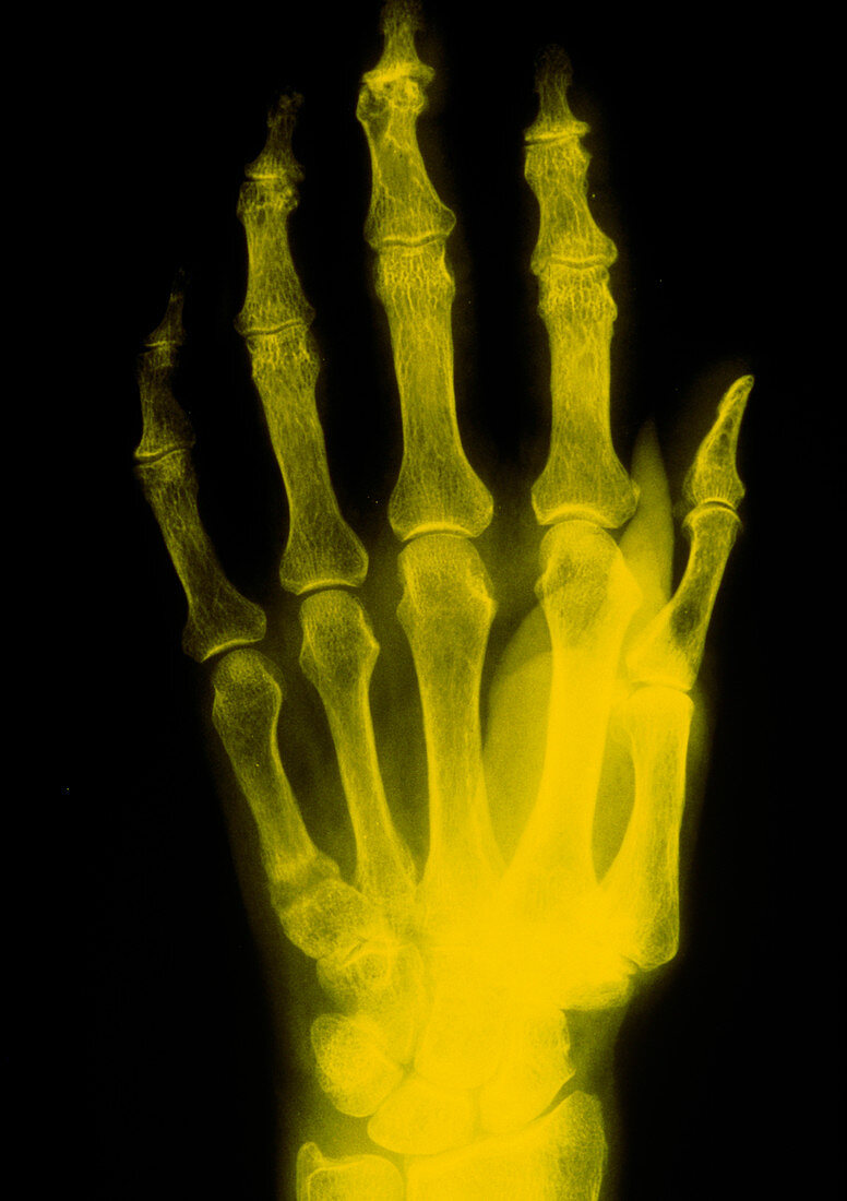 False col x-ray image of hand showing osteomalacia