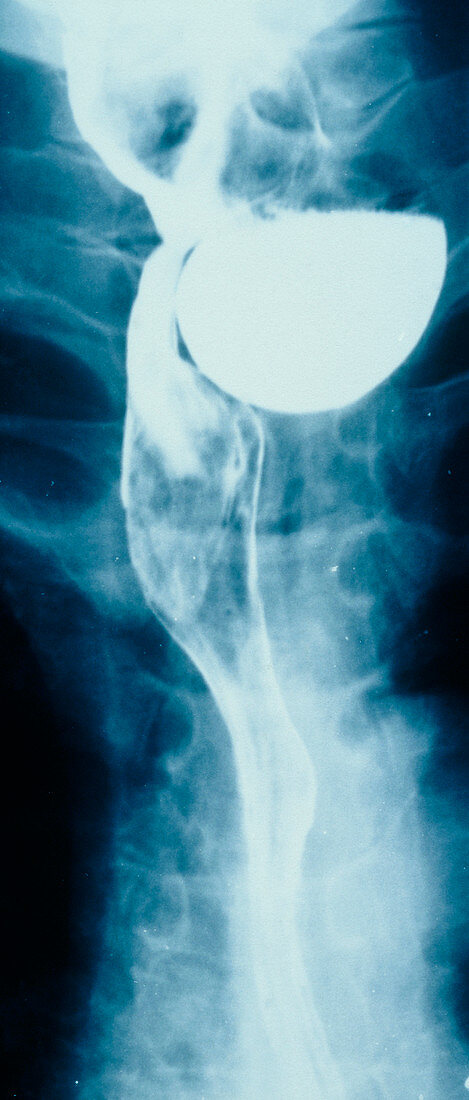 Bariium swallow x-ray showing weakness in muscle