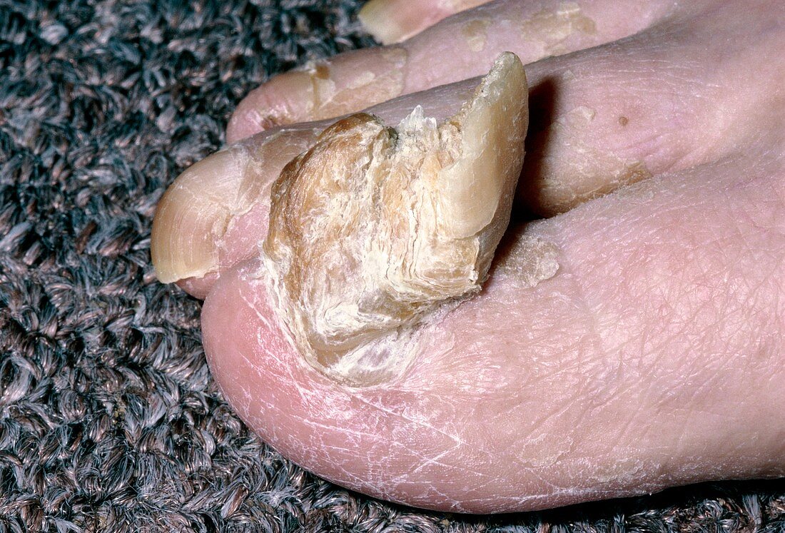 Onychogryphosis or abnormal growth of the toenail