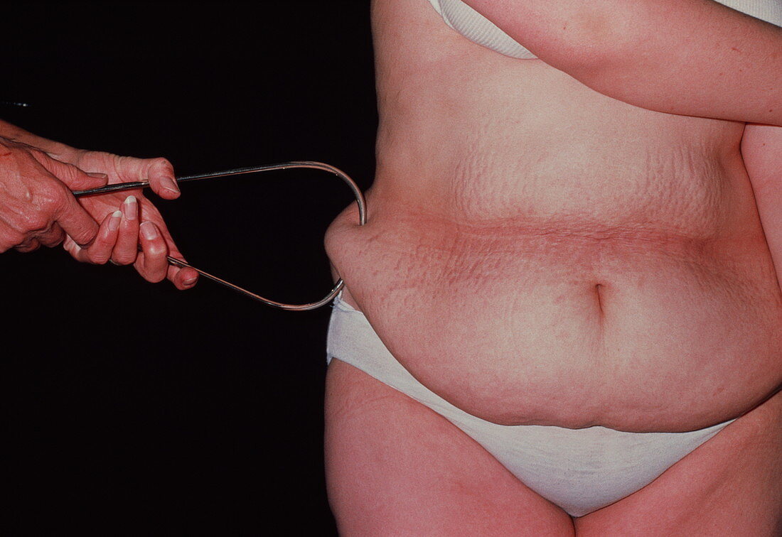 Fat measurement of obese woman with callipers