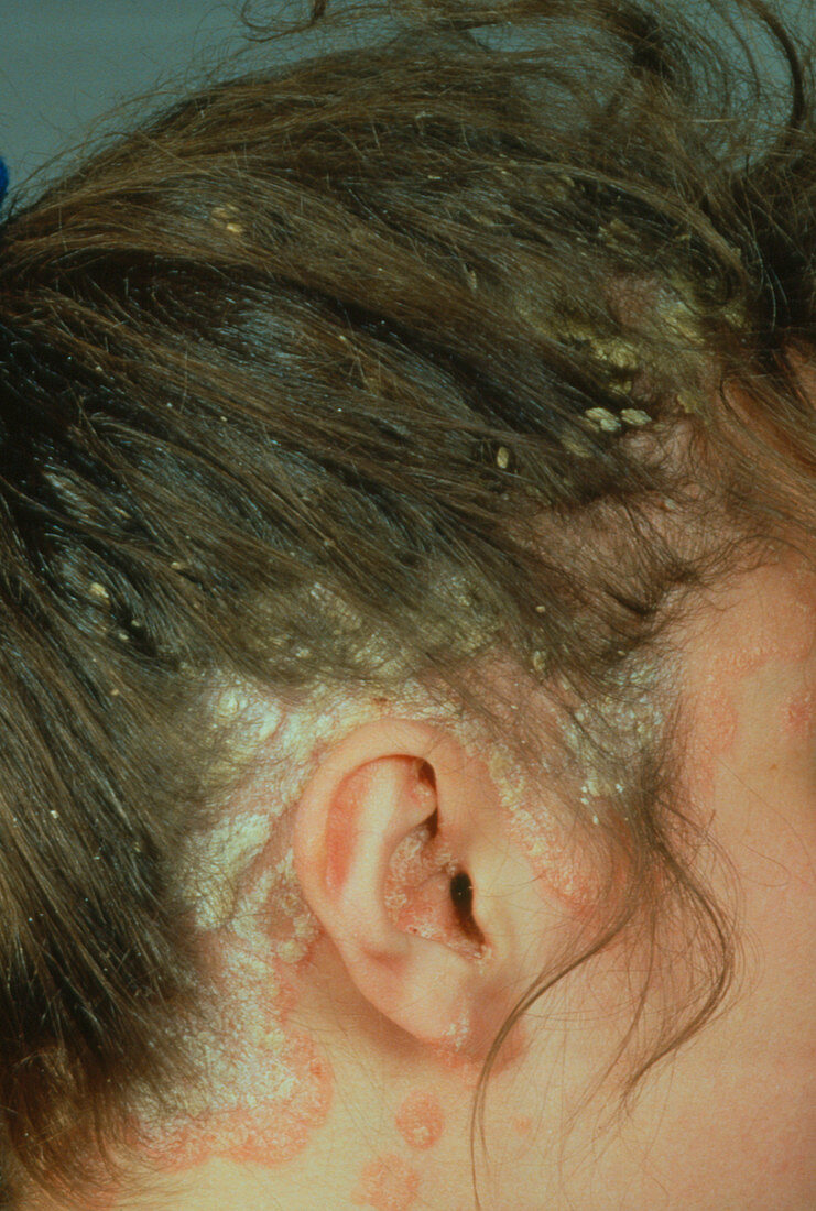 Young woman with psoriasis,side view of head
