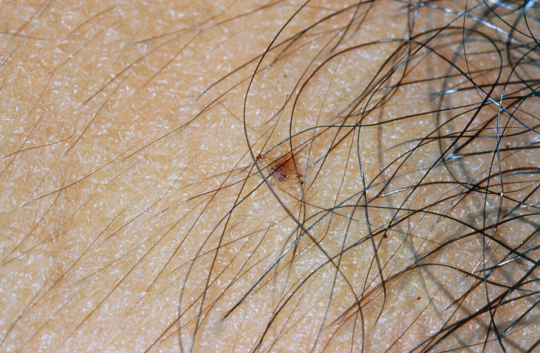 Pubic louse clining to human hair