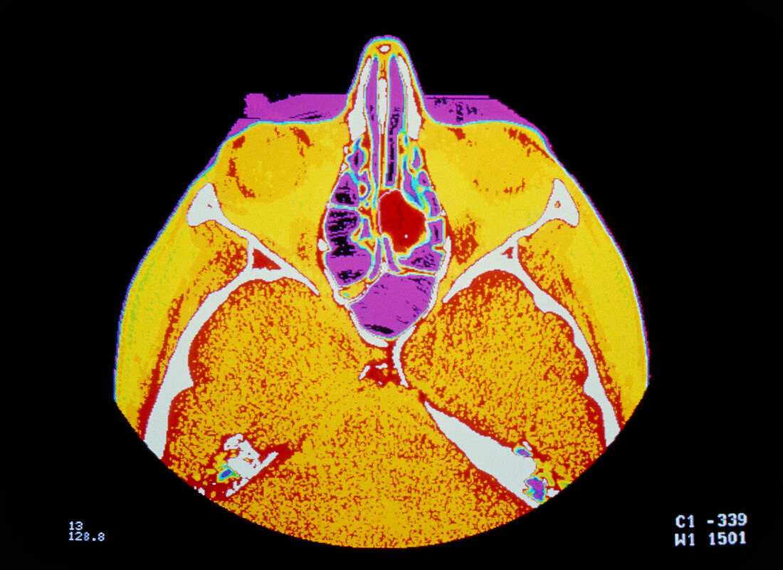 False-colour CT scan of a head showing nasal polyp