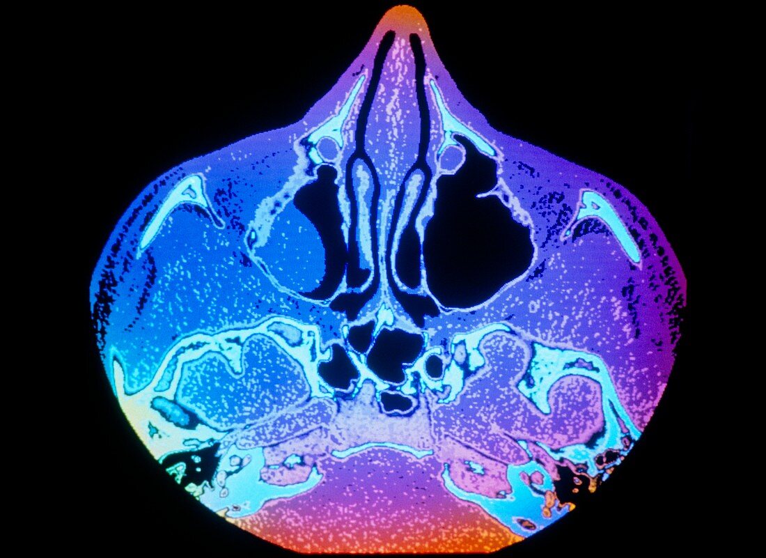 Coloured CT scan showing a large polyp in a sinus