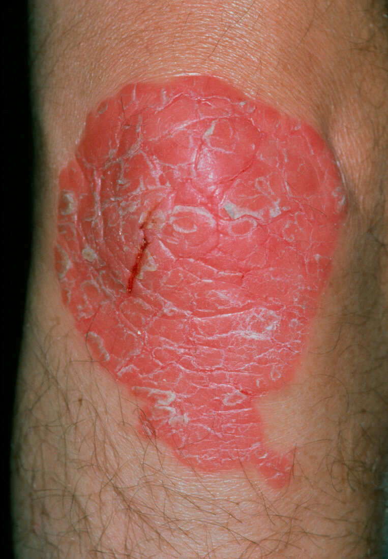 Psoriasis on the skin of the knee