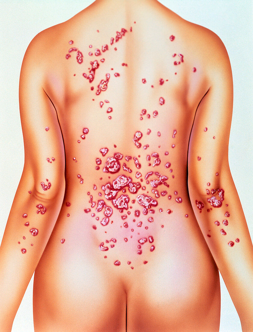 Artwork of psoriasis on woman's back
