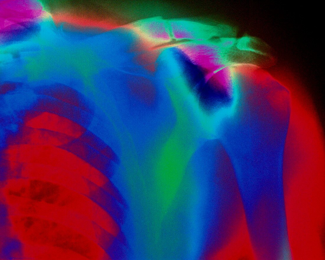 X-ray of a fractured clavicle in Paget's disease
