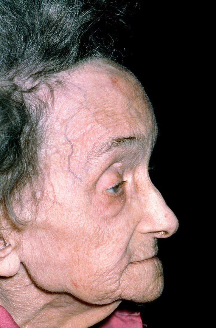 Abnormal prominent forehead due to Paget's disease