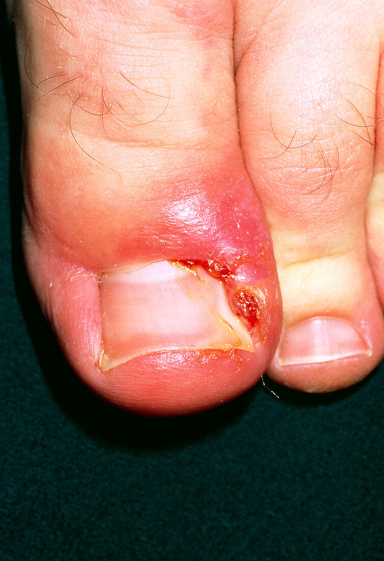 Close-up of paronychia due to an ingrowing toenail