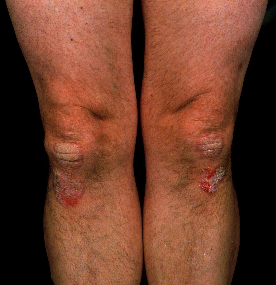 Psoriasis on the skin of a person's knee
