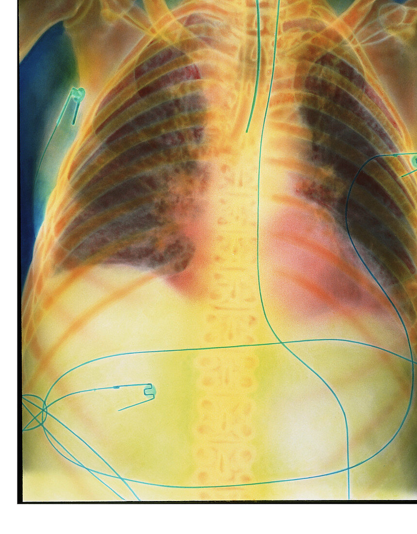 Coloured X-ray of pneumothorax treatment