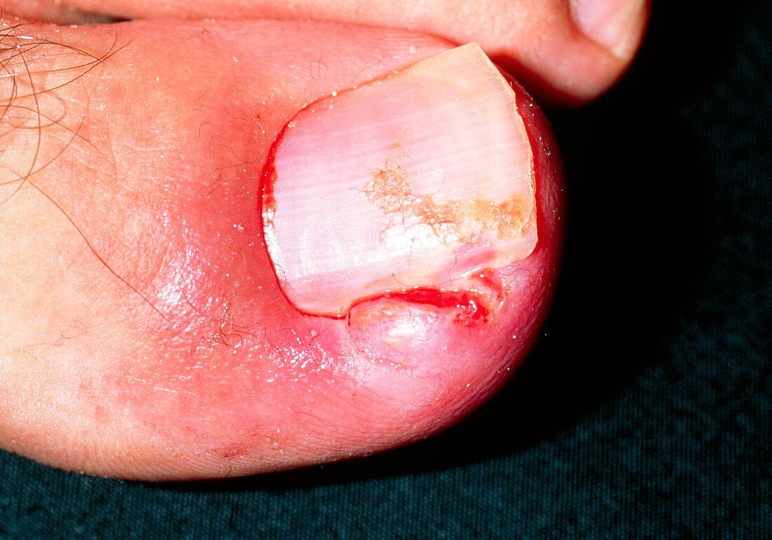 Close-up of paronychia due to an ingrowing toenail
