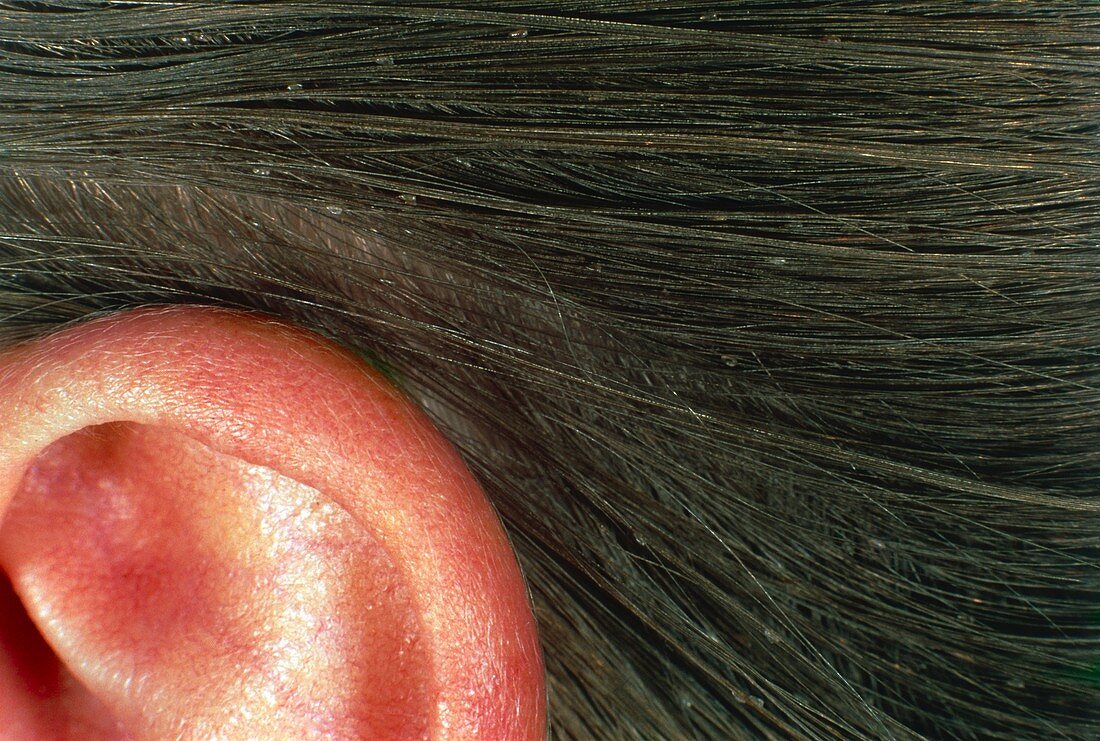 Nits head louse eggs in human hair