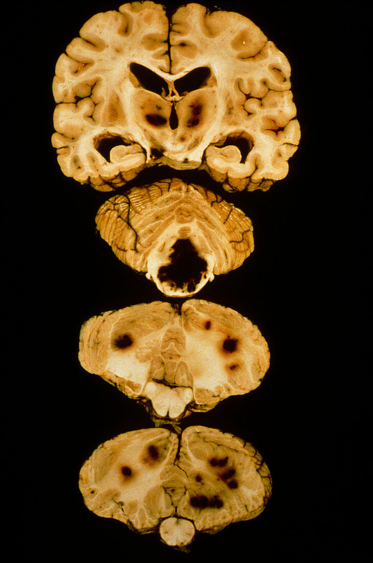 Polyarteritis nodosa,brain slices