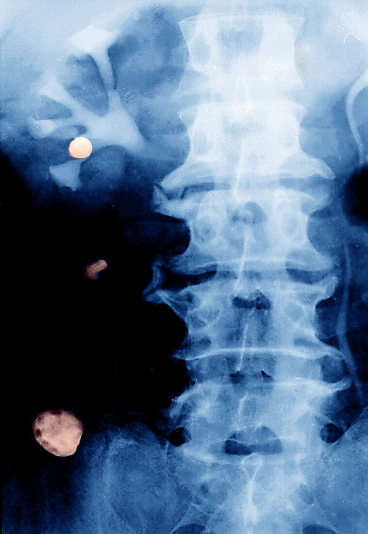 Porocephaliasis infection,X-ray