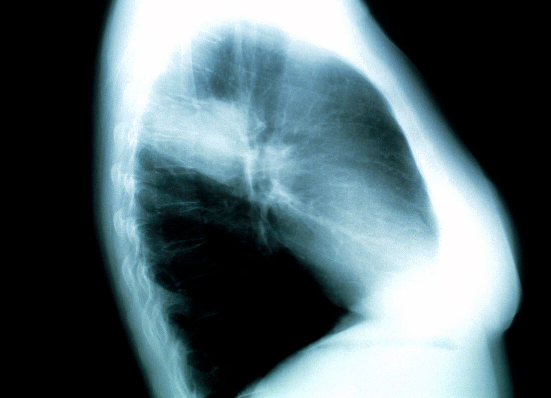 Pneumonia,X-ray