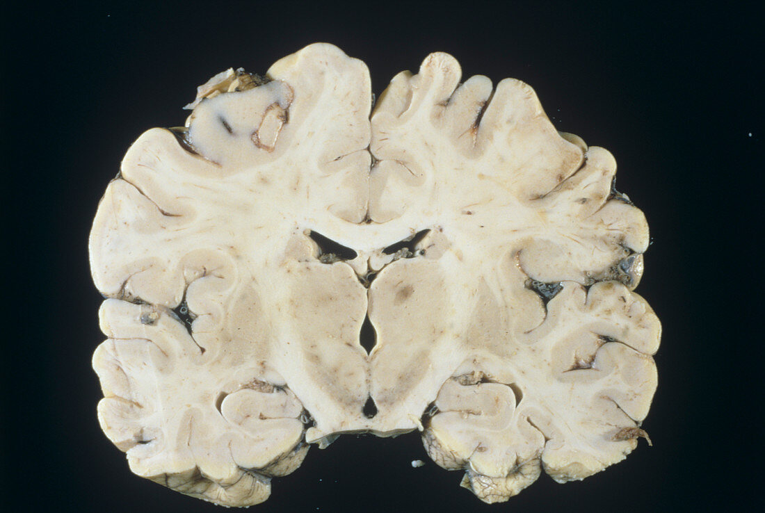 Oedema in the brain