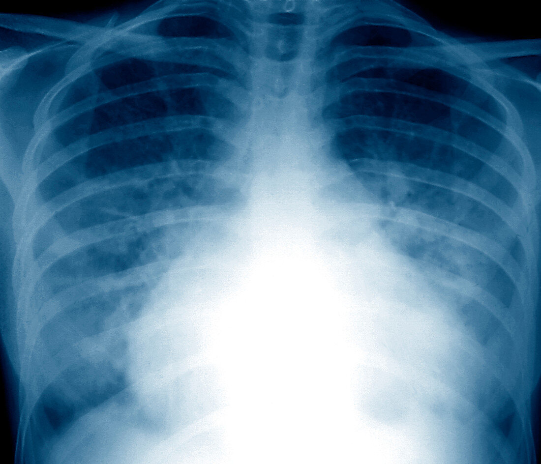 Flash pulmonary oedema,X-ray