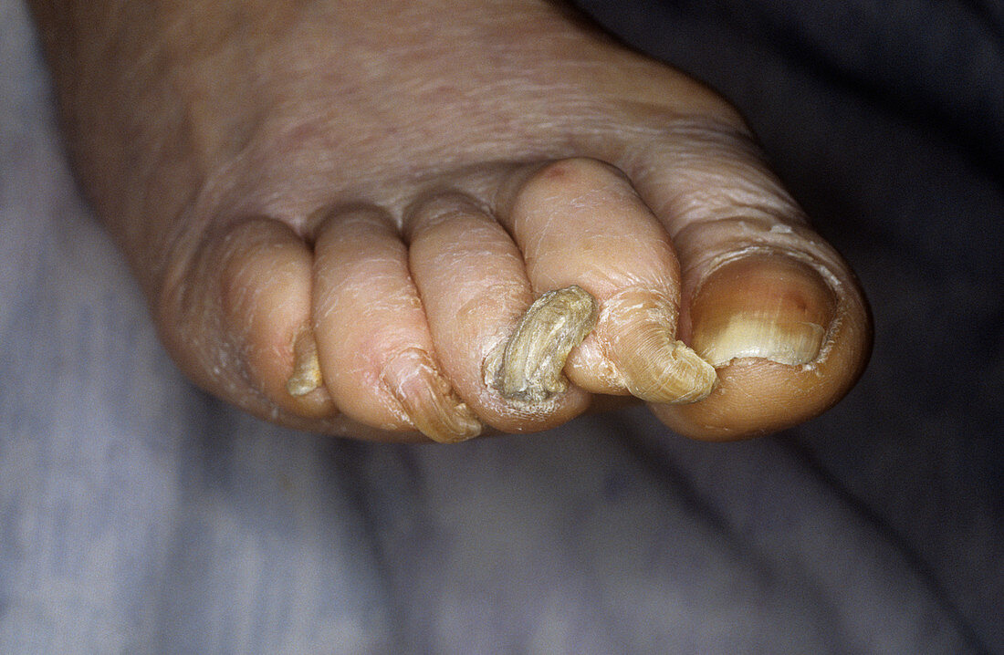 Deformed toenails