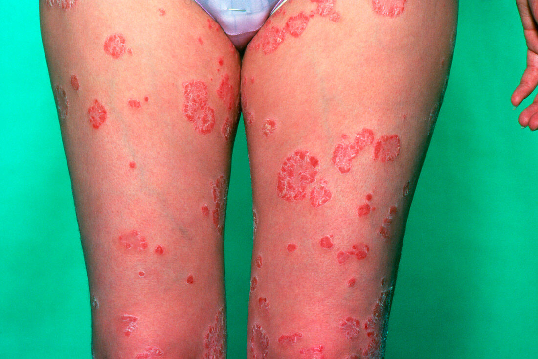 Psoriasis affecting a young womans's upper legs