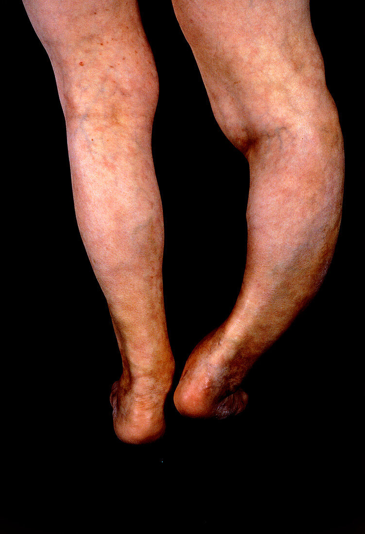 Severe deformity of leg caused by pagets disease