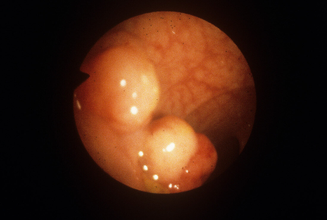 Colonic polyps,endoscope view