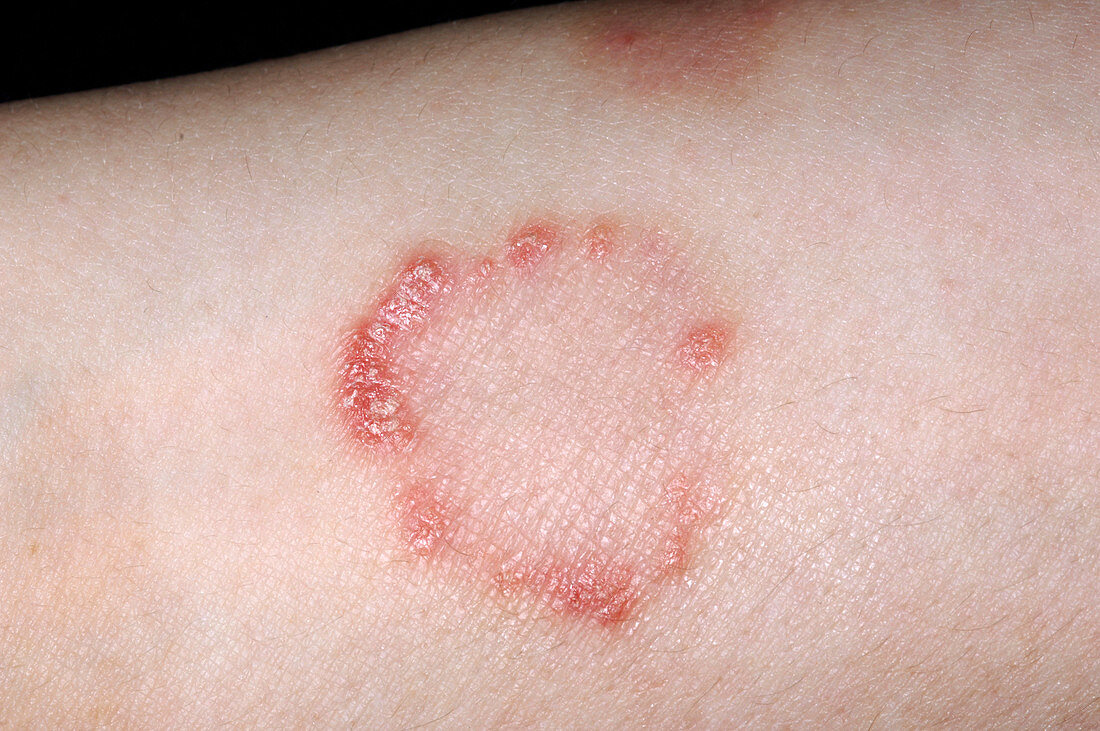 Psoriasis after 8 weeks of treatment