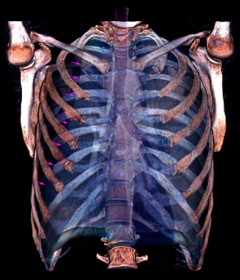 Pneumothorax,3D CT scan