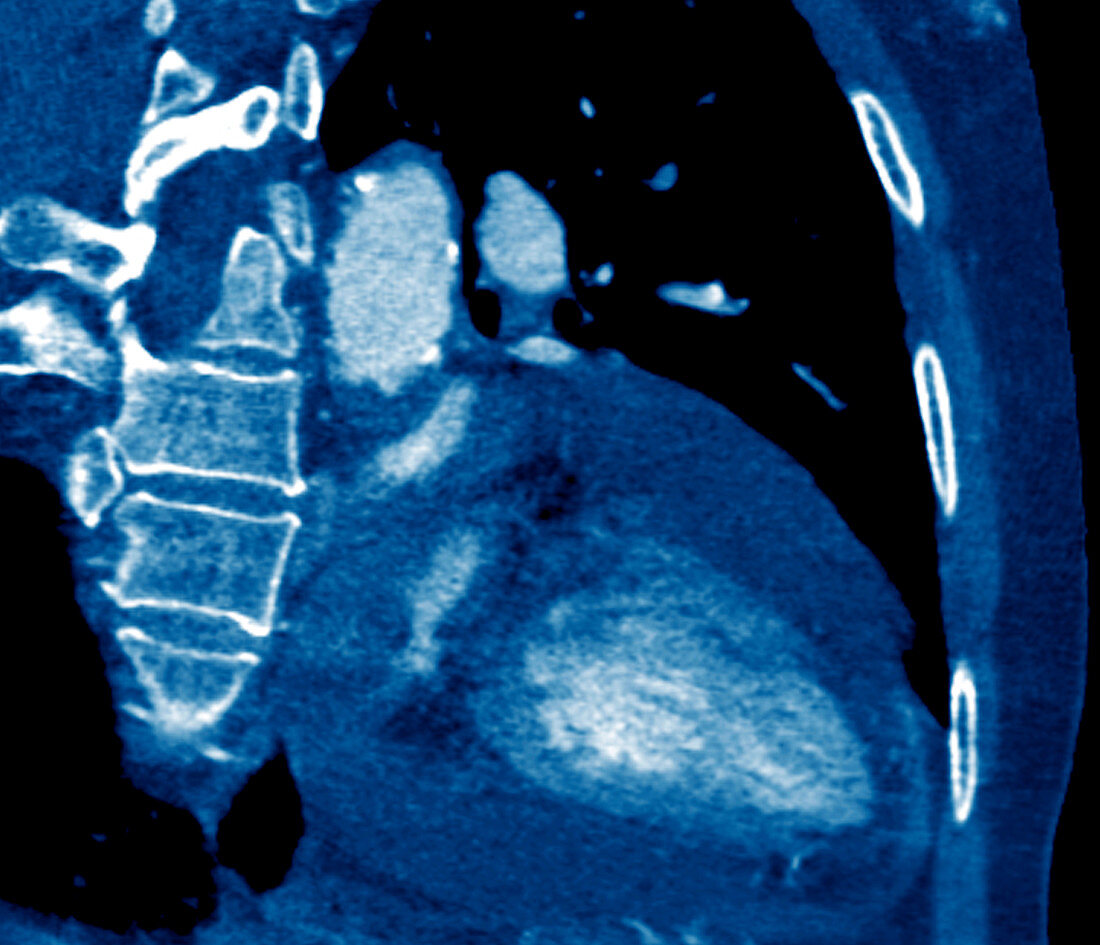 Pericardial effusion,CT scan