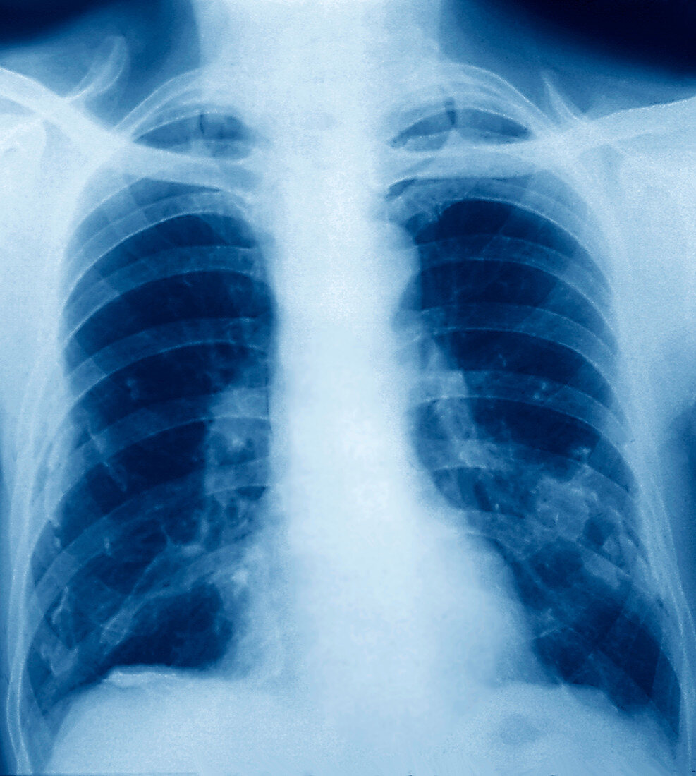 Pleural calcification,X-ray