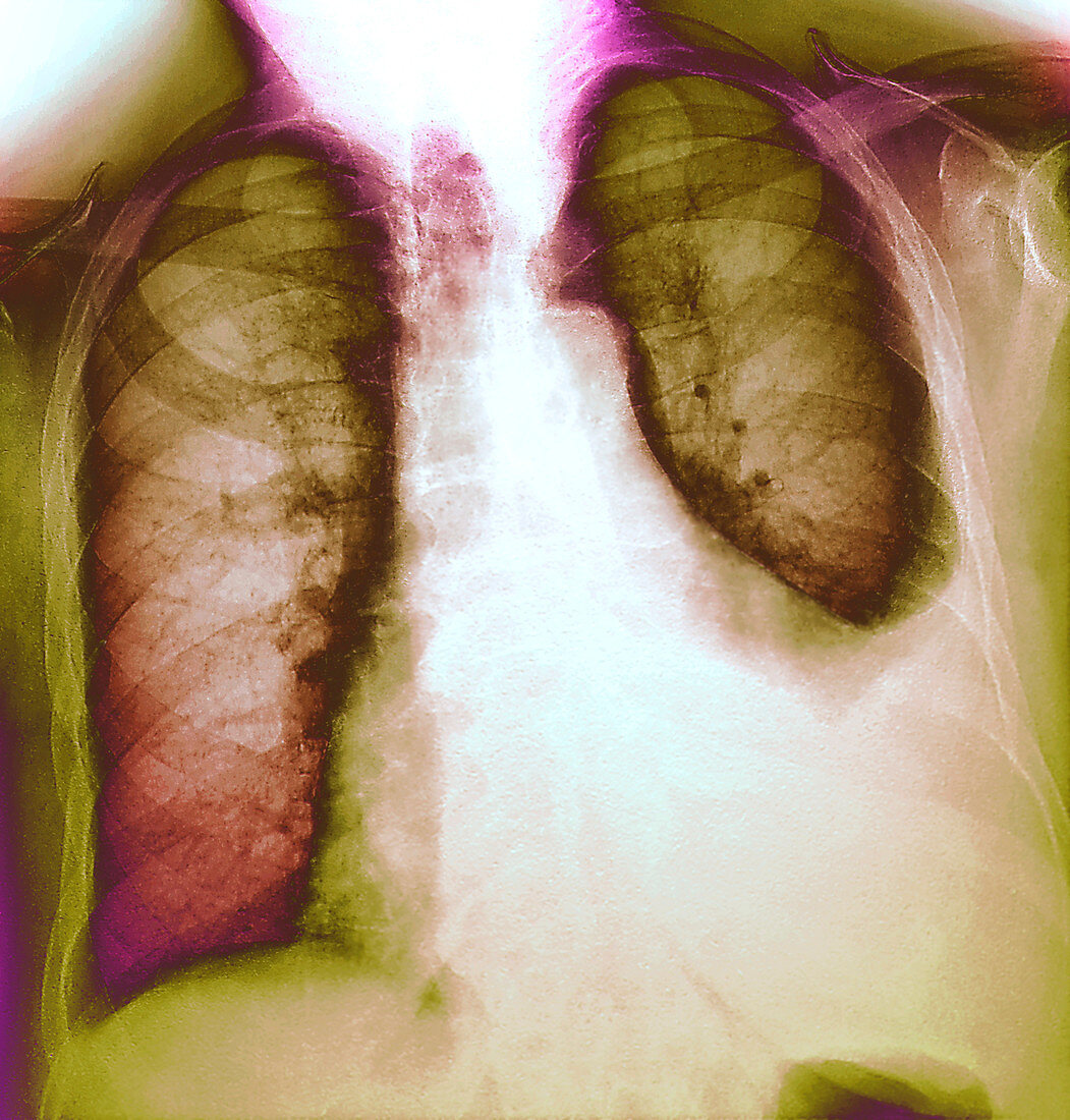 Lung infection,X-ray