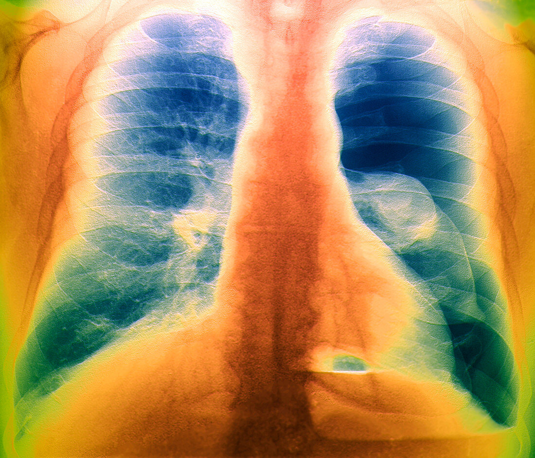 Pneumothorax,X-ray