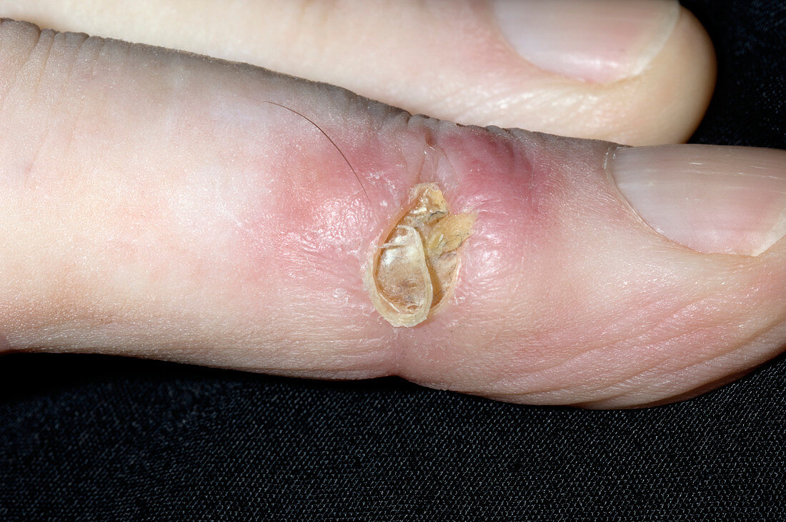 Pyoderma ulcer
