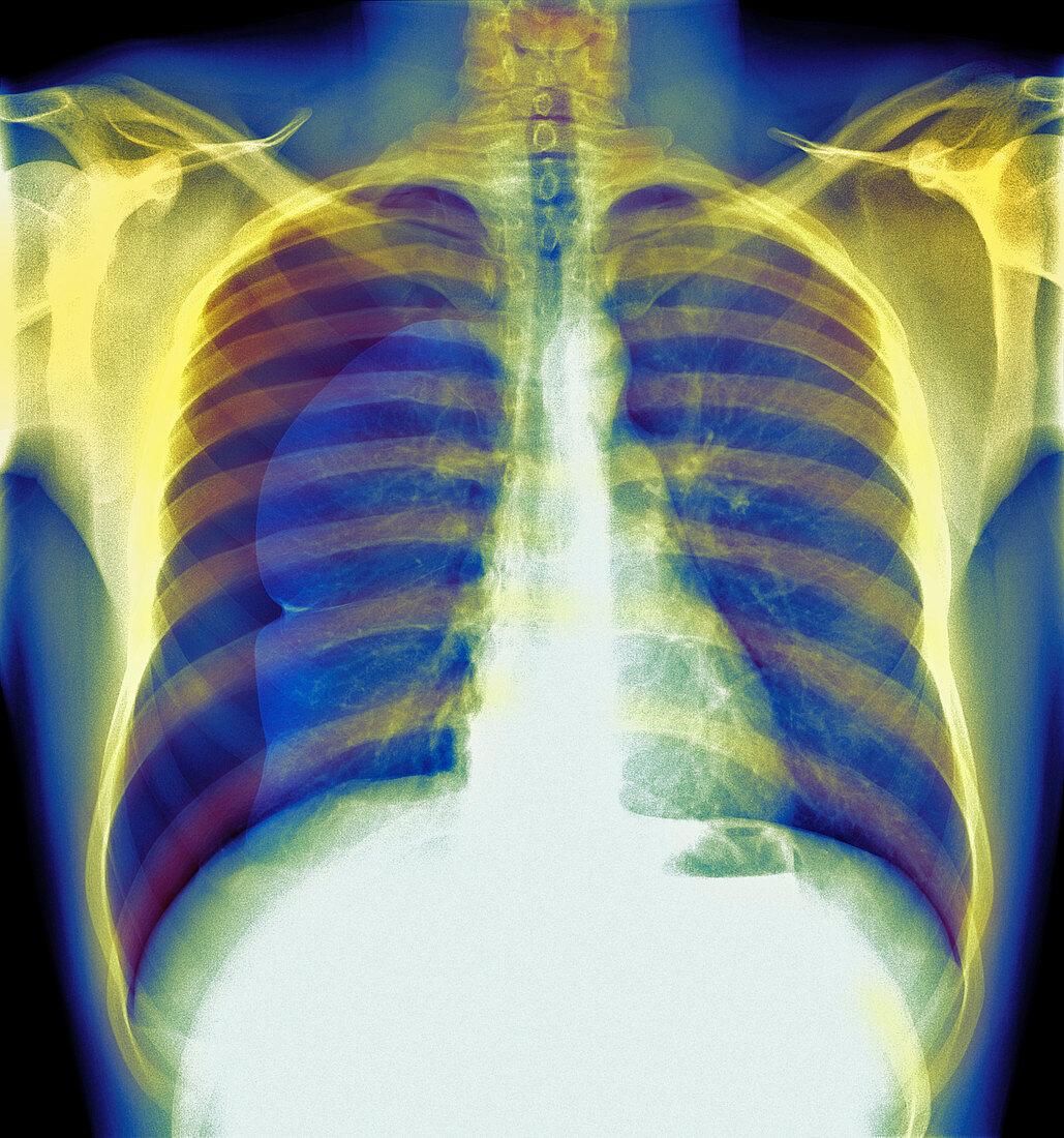 Pneumothorax,X-ray