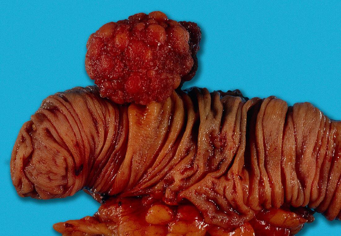 Polyp of the colon