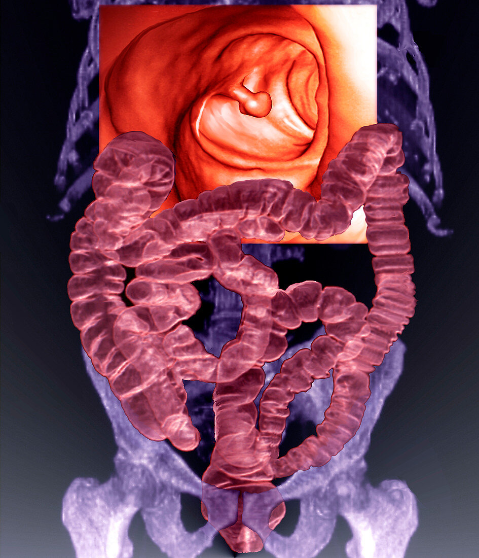 Intestines with colon polyp