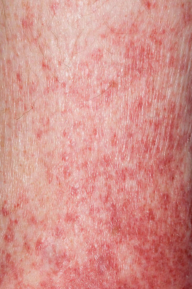 Petechial rash