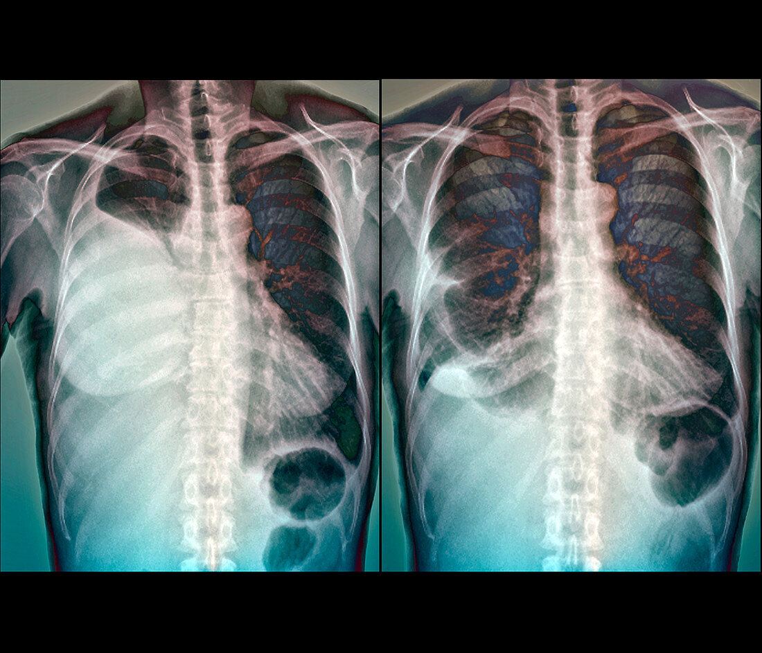 Pleurisy,X-ray